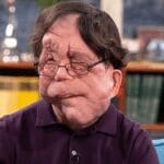 Adam Pearson, disfigured, Oscars, disability